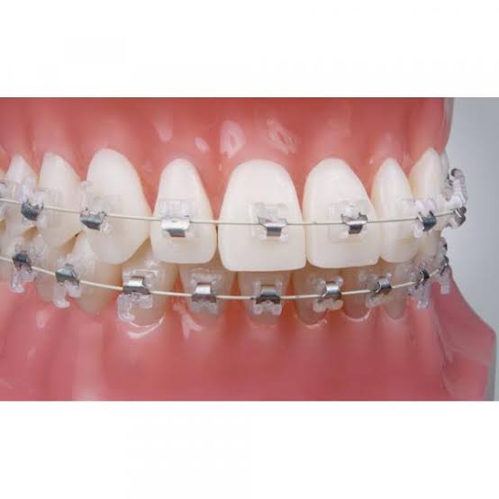Self-ligating Braces